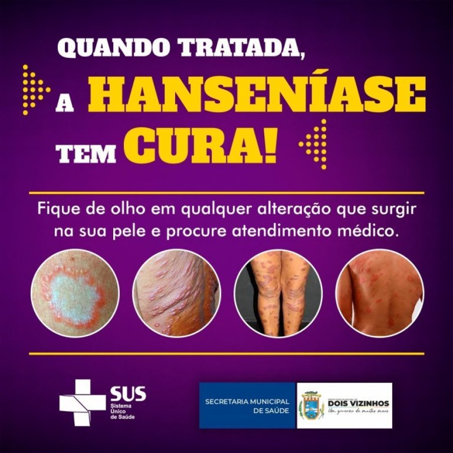 Dois Vizinhos � o Munic�pio Com Mais Casos de Hansen�ase da Regi�o